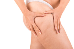 Consigli dietetici per la cellulite